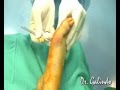 Juanetes.Hallux Valgus.Dr E G Andújar & Dr E Galindo Martens