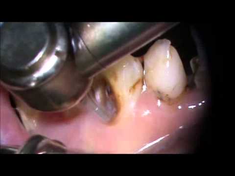 how to fix tooth decay