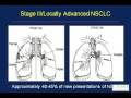 GRACEcast-013_Lung-Cancer_Suresh Ramalingam NSCLC Interview