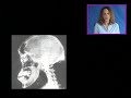 Anterior Pituitary Acromegaly and Giantism