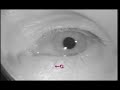 positional nystagmus 2