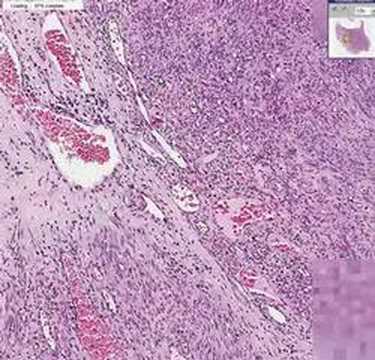 Histopathology Skin--Kaposi sarcoma