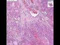 Histopathology Skin--Kaposi sarcoma