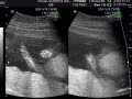 17 1/2 weeks Ultrasound...Is it a boy or girl?