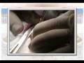 ΒΛΕΦΑΡΟΠΛΑΣΤΙΚΗ  Live surgery!  4  Νώντας Καποσίτας MD.PhD.