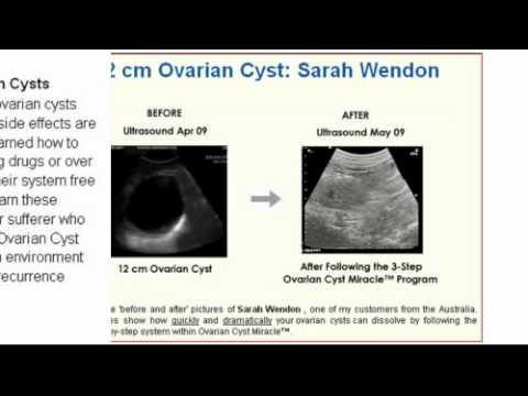how to treat pcos at home