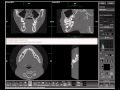 Tips &amp; Tricks Video: Creating a Panorex View of the Mandible