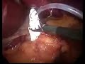 The Operation: Lap Band Surgery