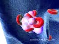 Embolismo pulmonar.AVI