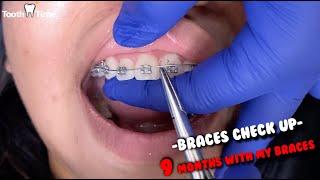 Braces Check up - 9 months with my braces recap - 