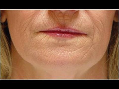 how to cure smokers lips