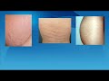 Stretch Mark Removal