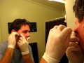 SEBACEOUS CYST...Taking matters in my own hands!!