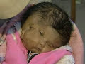 Baby born with two faces, four eyes, two noses, two mouths