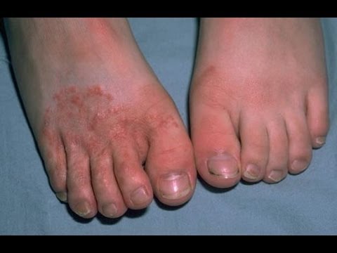 how to cure fungal infection on feet