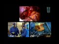 Colorectal sigmoid colectomy Colectomy