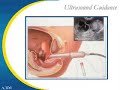 Specifics of an IVF Cycle Specifics of an IVF Cycle