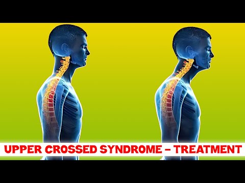how to treat upper crossed syndrome