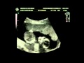 ultrasson 14 semanas