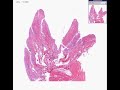 Histopathology Joint--Rheumatoid arthritis Histopathology Joint--Rheumatoid arthritis