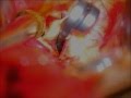 Brain aneurysm-giant posterior communicating artery aneurysm-microsurgery