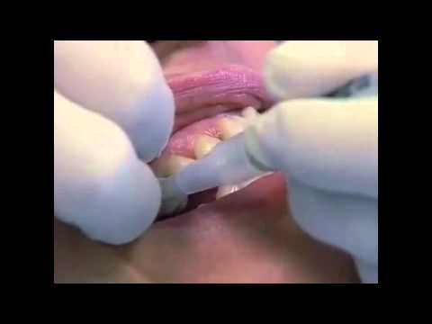 how to whiten dental fillings