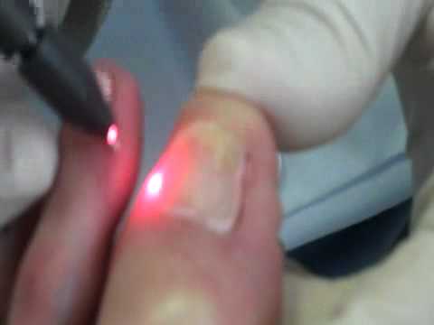 toenail