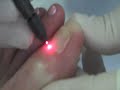 Medical Nail Technician- Athena Elliott introduces Dr. Sherman Nagler ,who demonstrates a new laser procedure that kills the pathogens that cause toenail fungus! An Alternative to Topical and Oral Treatments Says It Can Kill Fungus Instantly!