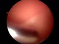 Patellar Tendon Surgery 2