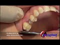 SIMPLIFIED IMPLANT TEMPORARY TECHNIQUE