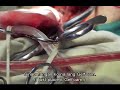 Brain Operation in Butuan in Ilonggo Cebuano Visaya 1B
