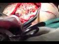 Brain Operation in Butuan in Ilonggo Cebuano Visaya 1B