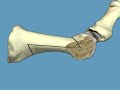 osteotomy of the first met