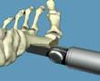 osteotomy of the first met