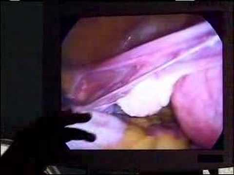 Minimally Invasive Hysterectomy