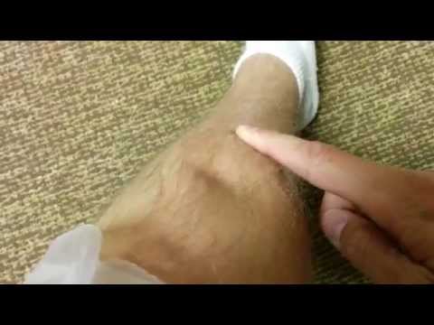 how to cure pitting oedema