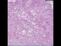 Histopathology Lung-- Adenocarcinoma Histopathology Lung-- Adenocarcinoma