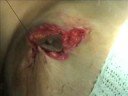 Reduction Mammaplasty ( teaching )Prof. F. Alkhairy Reduction Mammaplasty ( teaching )Prof. F. Alkhairy