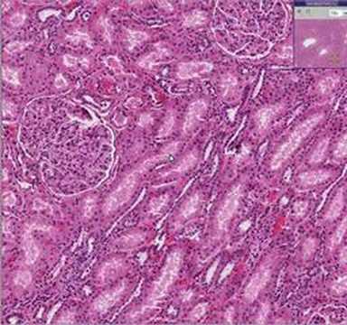 Histopathology Kidney--Eclampsia