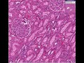 Histopathology Kidney--Eclampsia