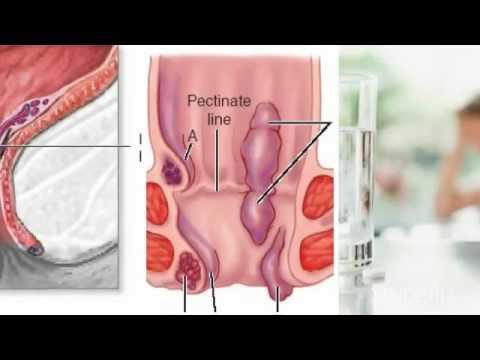 how to cure outside piles