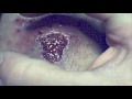 Brown Recluse Spider Bite... This is So GROSS!!!