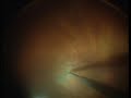 Click here to watch this video New ophthalmic surgery technique video: Removal of ILM in retinal detachment surgery