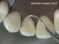 ClassIII Preparation