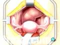 videos de Malpractice Medical Hysterectomy Removal of the Uterus Surgery 2