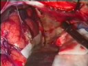 Craniopharyngioma Craniopharyngioma