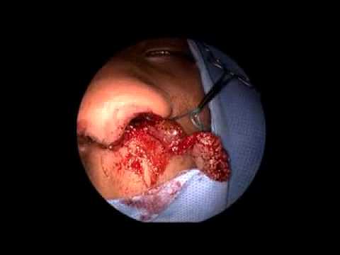 how to relieve blocked sinuses nhs