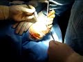 lipoma