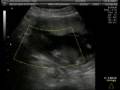 15 Weeks Fetus 3D Color Ultrasound