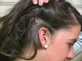 cu cochlear implants